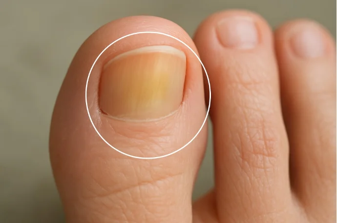 A Simple Remedy for Nail Fungus That Helps Clear Nails