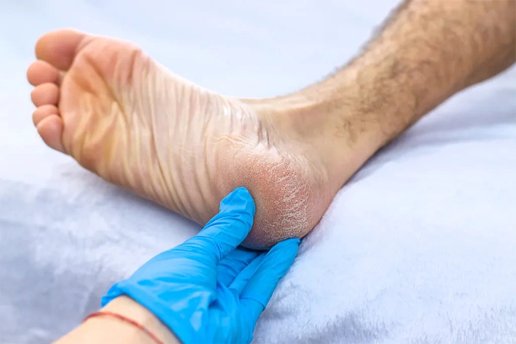 Cracked Heels